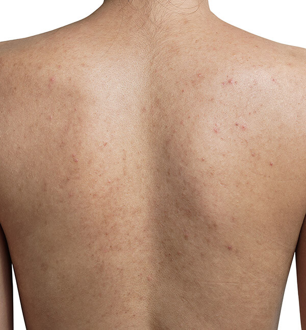 Before-Leke Tedavisi