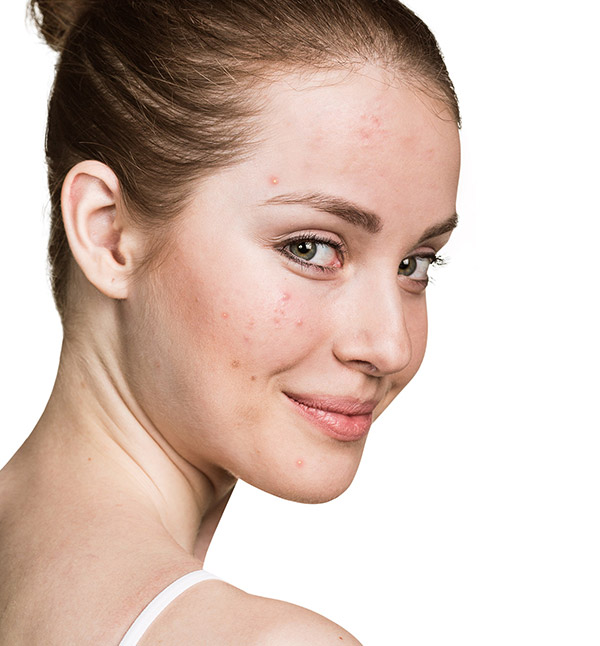 Before-Karbon Peeling